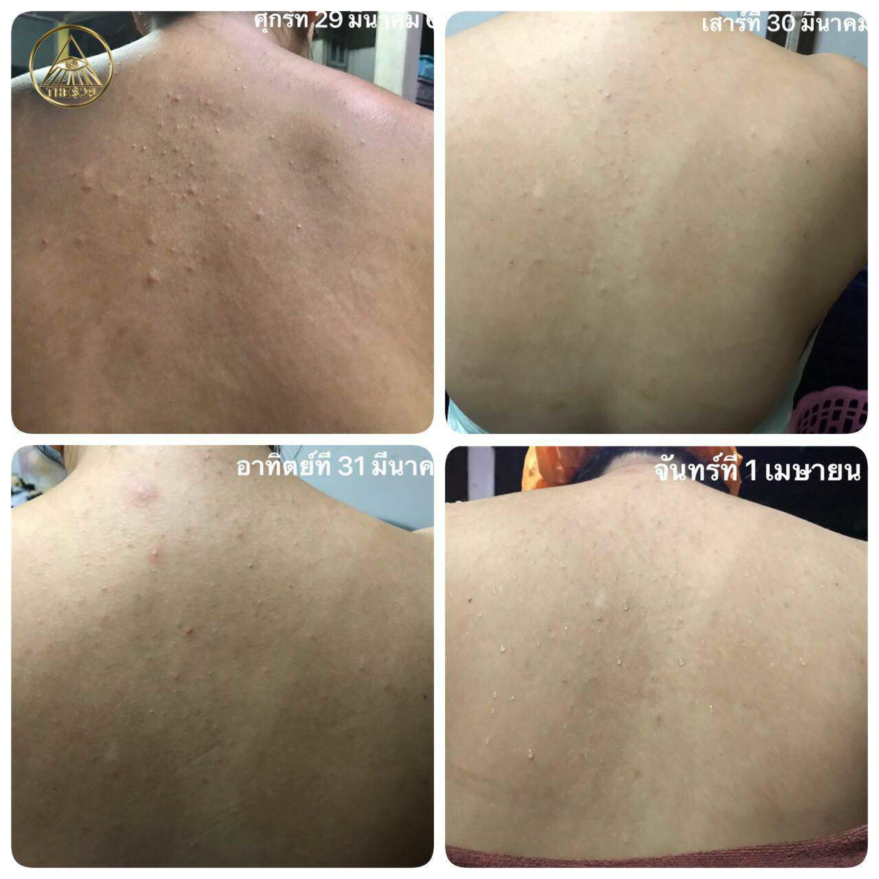 หลังเป็นสิวใช้ เพียวพลัส สบู่หิมะ