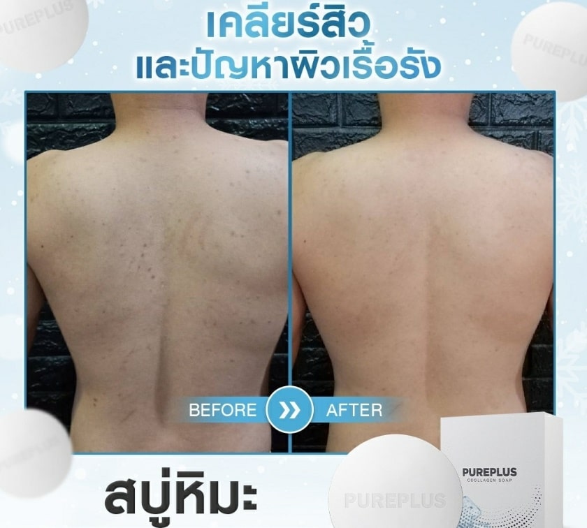 pureplus snow สบู่อาตุ่ย เคลียร์สิวที่หลัง