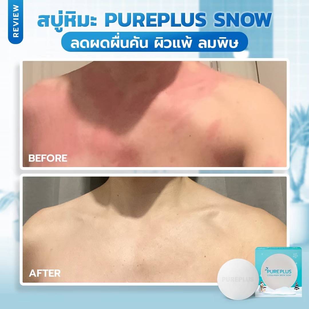 pureplus สบู่ อาตุ่ย ลดผดผื่นคัน
